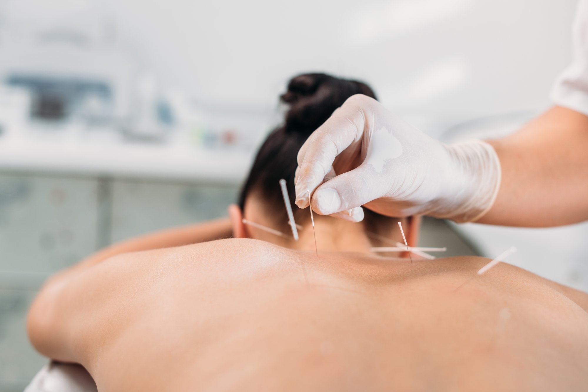 dry-needling