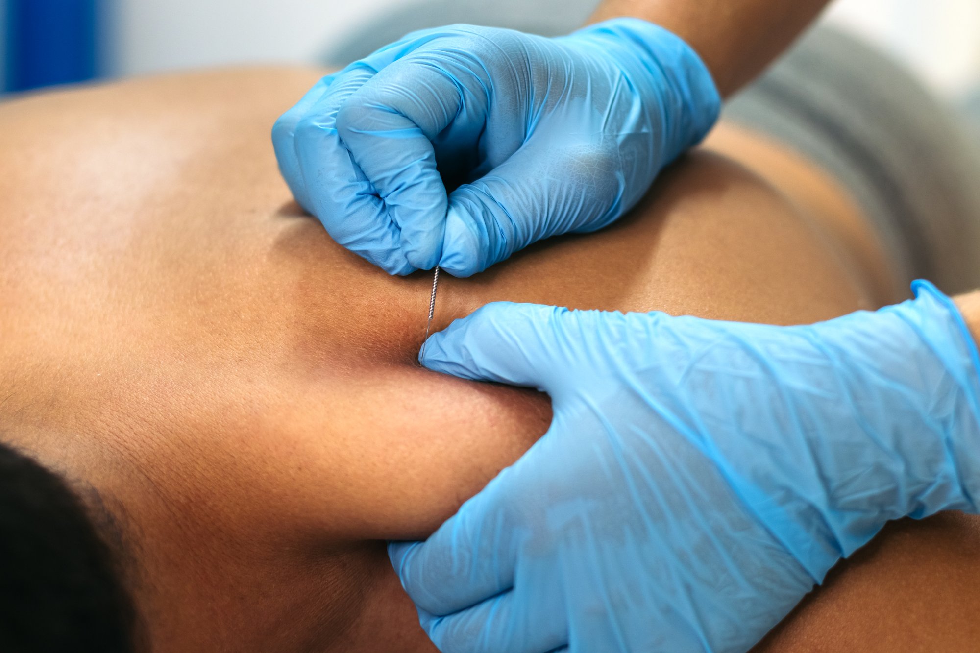 dry-needling
