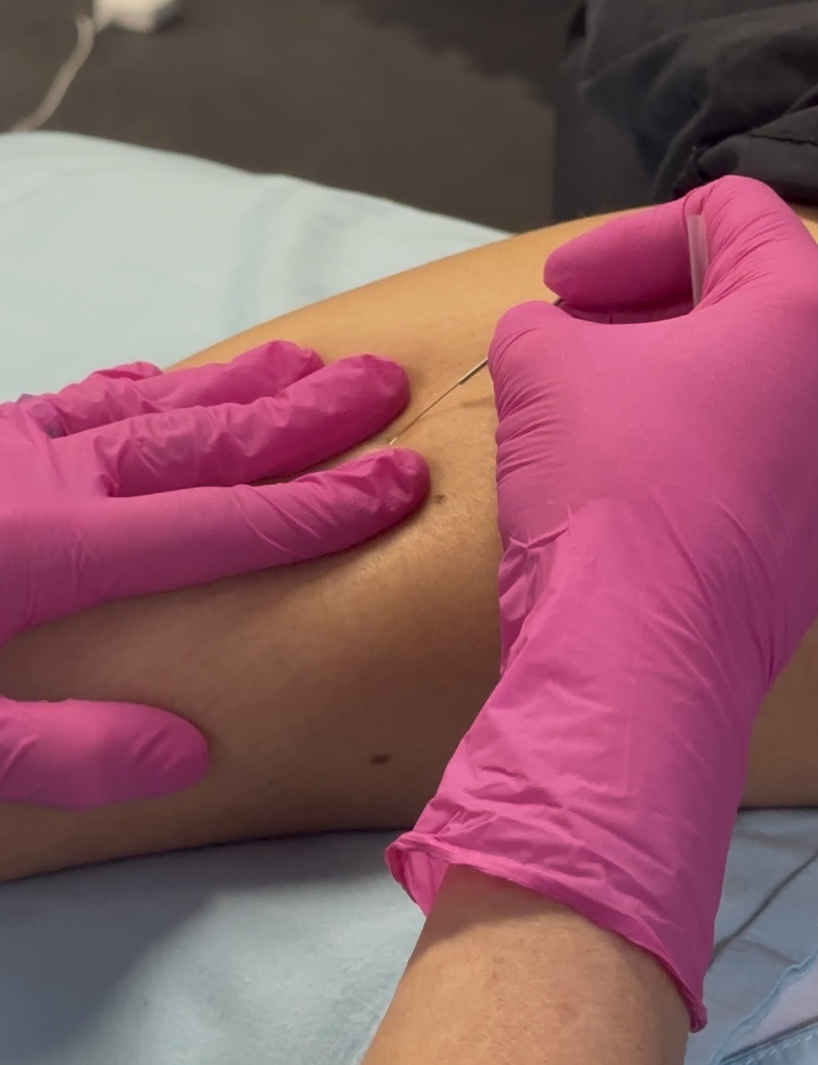 Dry-Needling
